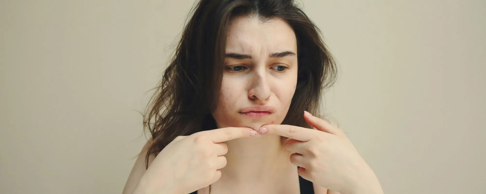 Acne 101 – Simple Treatments for Acne Prevention